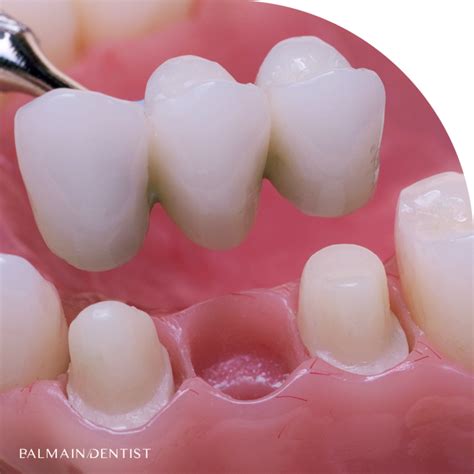 cheap dental crowns balmain